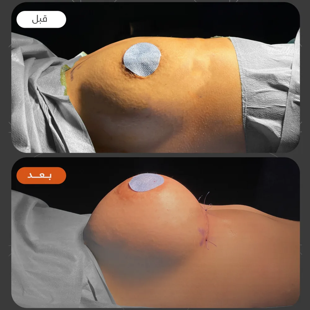 تجميل الثدي — قبل وبعد