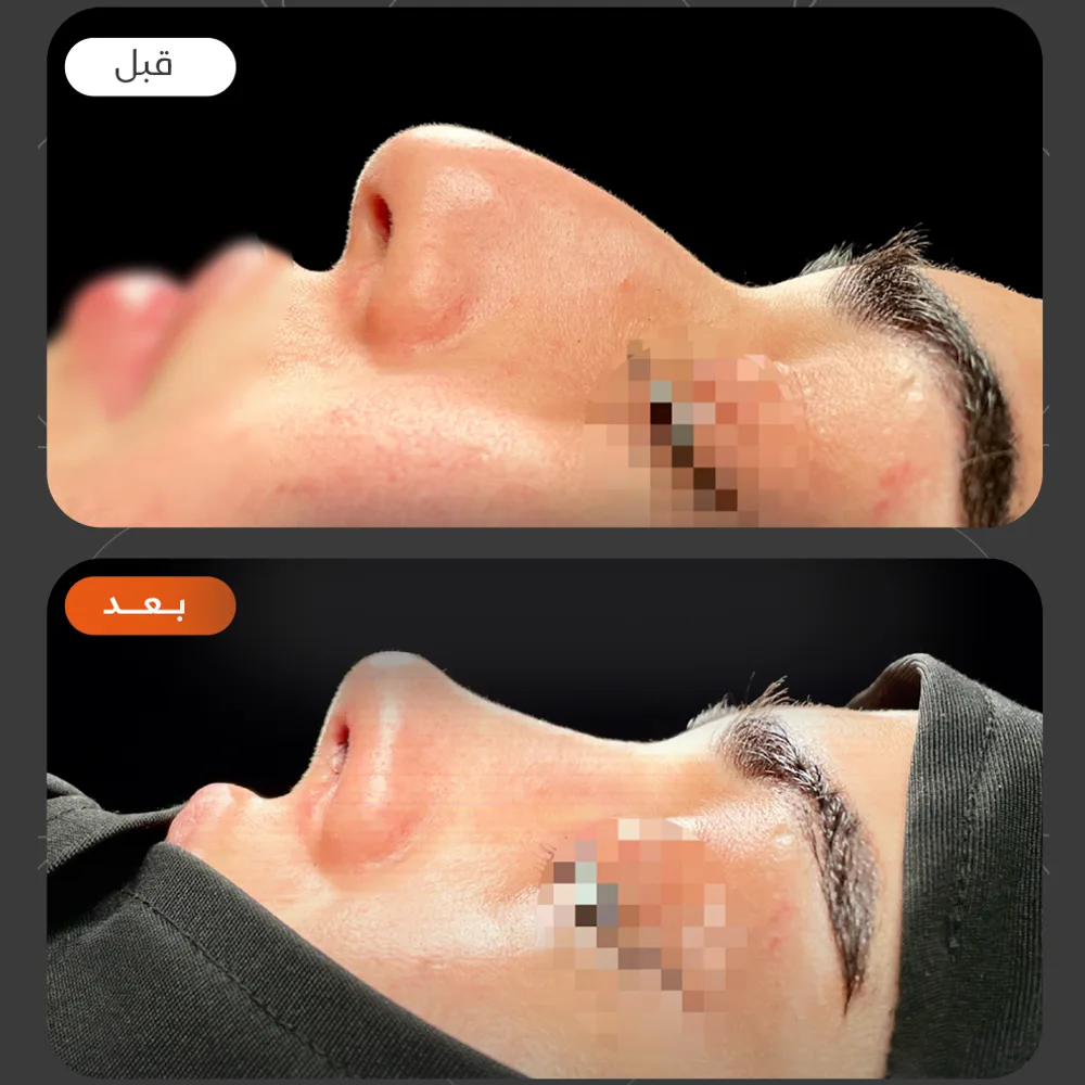 تجميل الانف — قبل وبعد