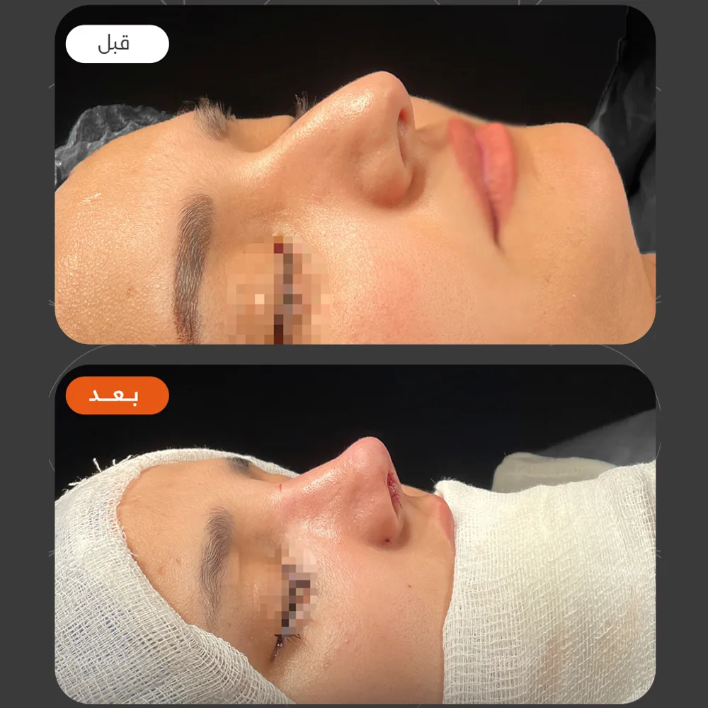 تجميل الانف — قبل وبعد