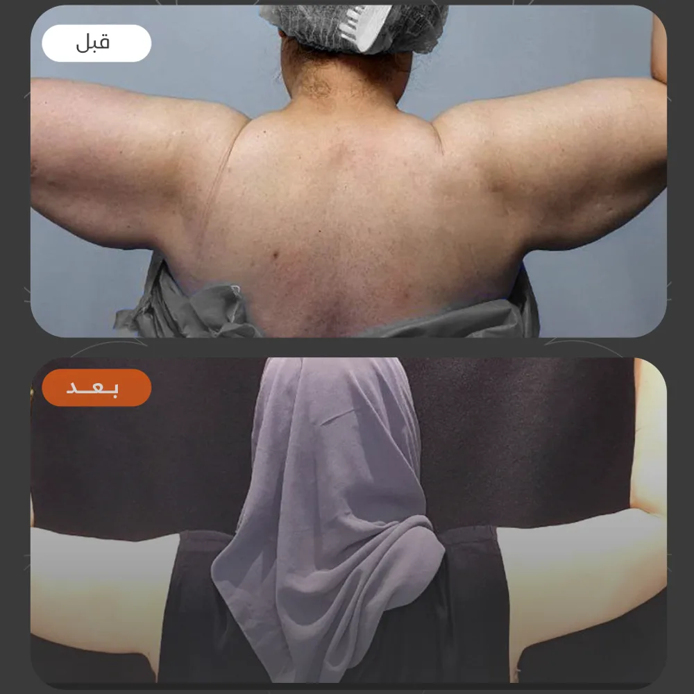 نحت الجسم — قبل وبعد