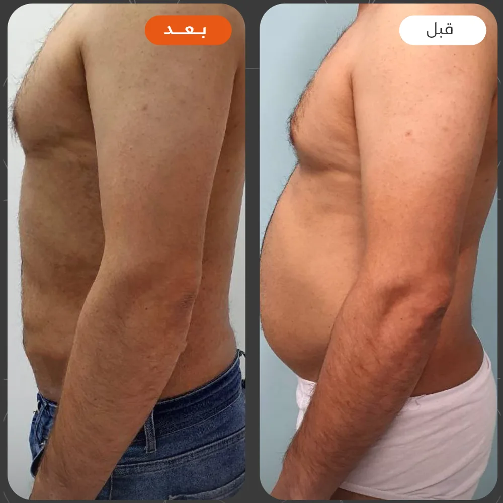 نحت الجسم — قبل وبعد