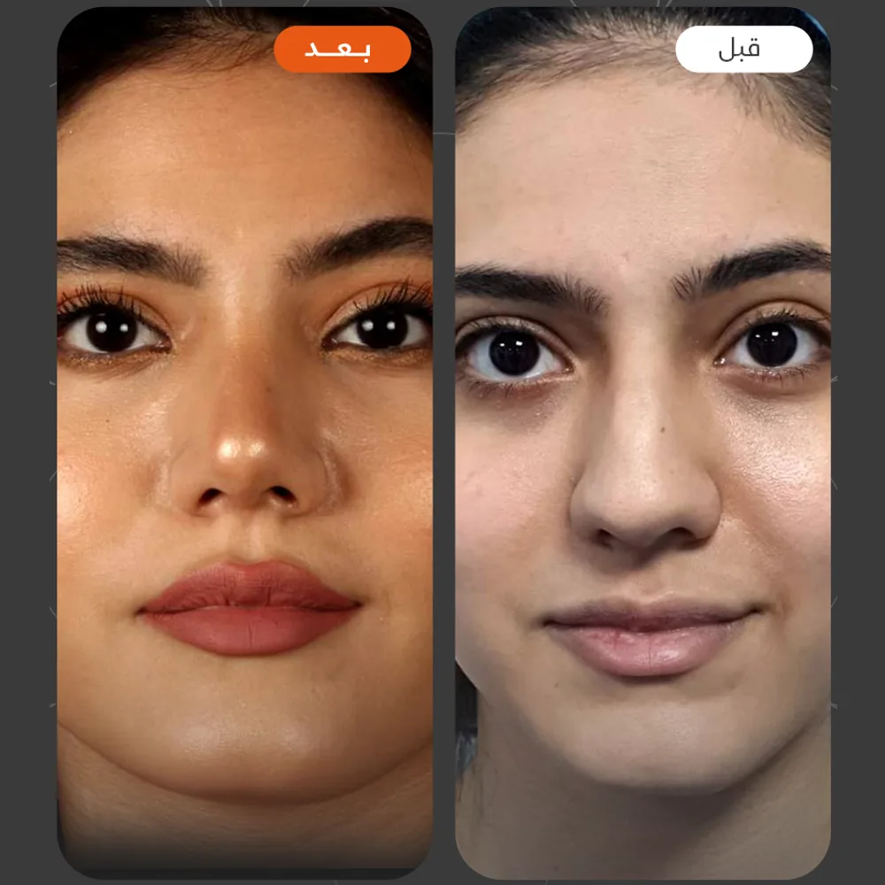 تجميل الانف — قبل وبعد