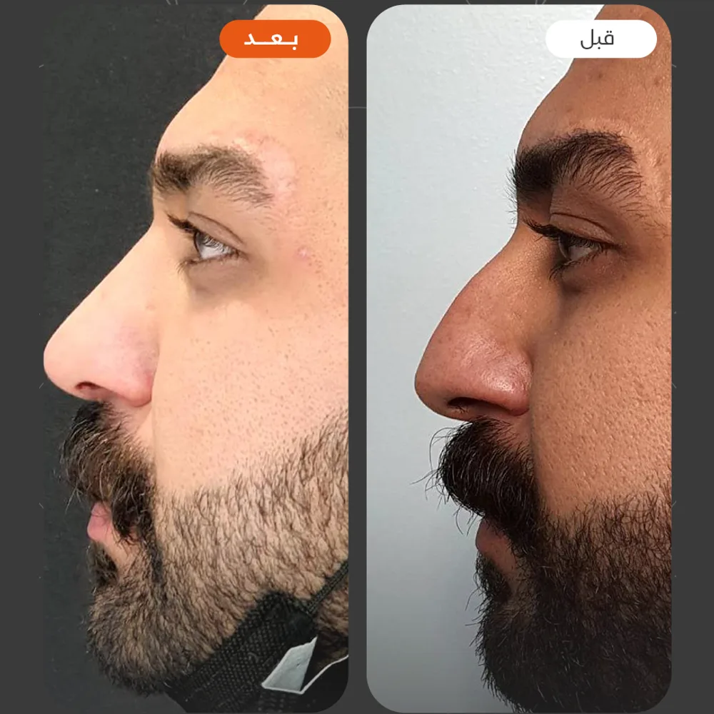 تجميل الانف — قبل وبعد